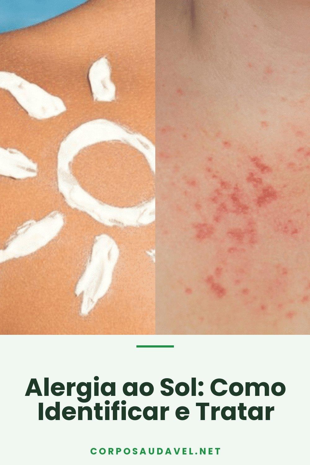 Alergia ao Sol: Como Identificar e Tratar