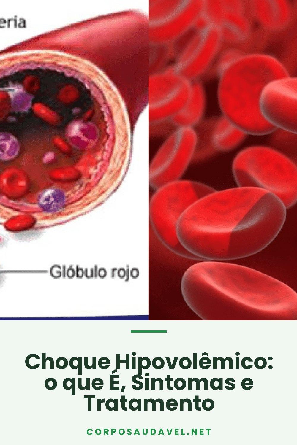 Choque Hipovolêmico: o que É, Sintomas e Tratamento