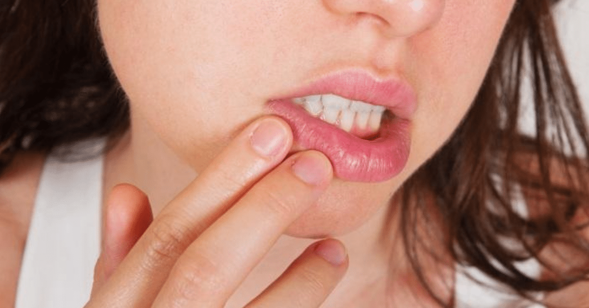 remedio caseiro para herpes labial