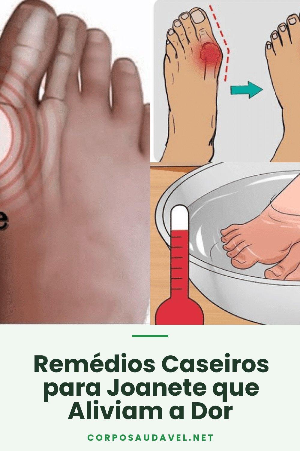 Remédios Caseiros para Joanete que Aliviam a Dor