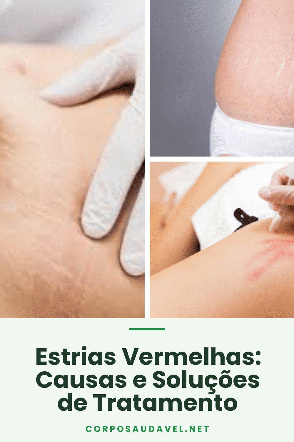 Estrias Vermelhas: Causas e Soluções de Tratamento
