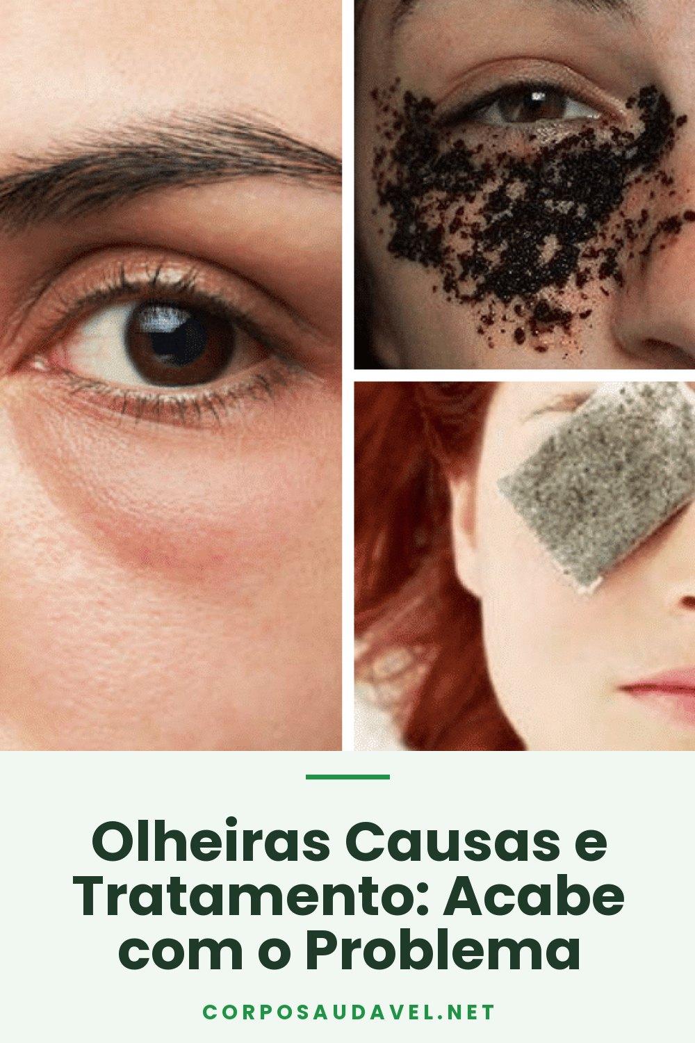 Olheiras Causas e Tratamento: Acabe com o Problema